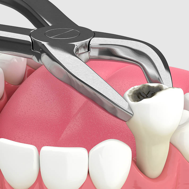 3d render of lower jaw with tooth extraction