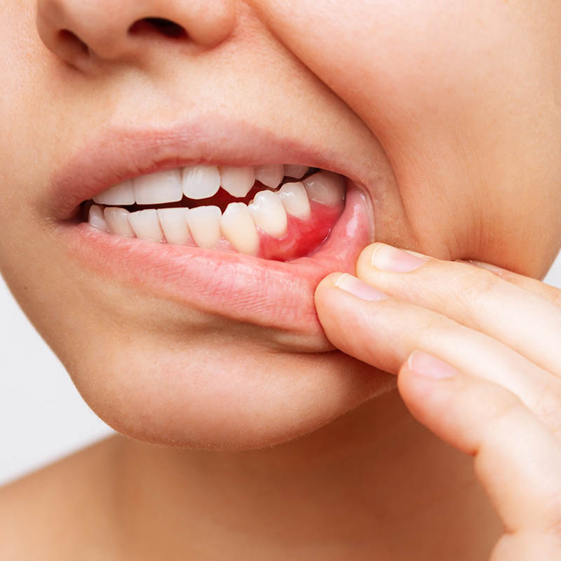 Gum inflammation. Cropped shot of a young woman showing red bleeding gums
