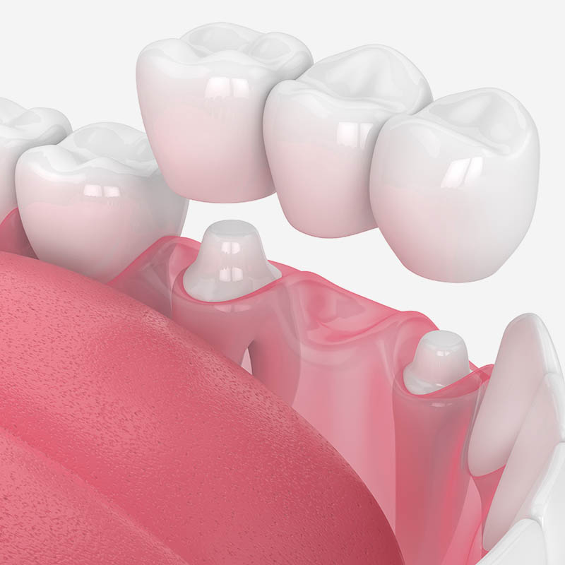 3d render of jaw with dental bridge
