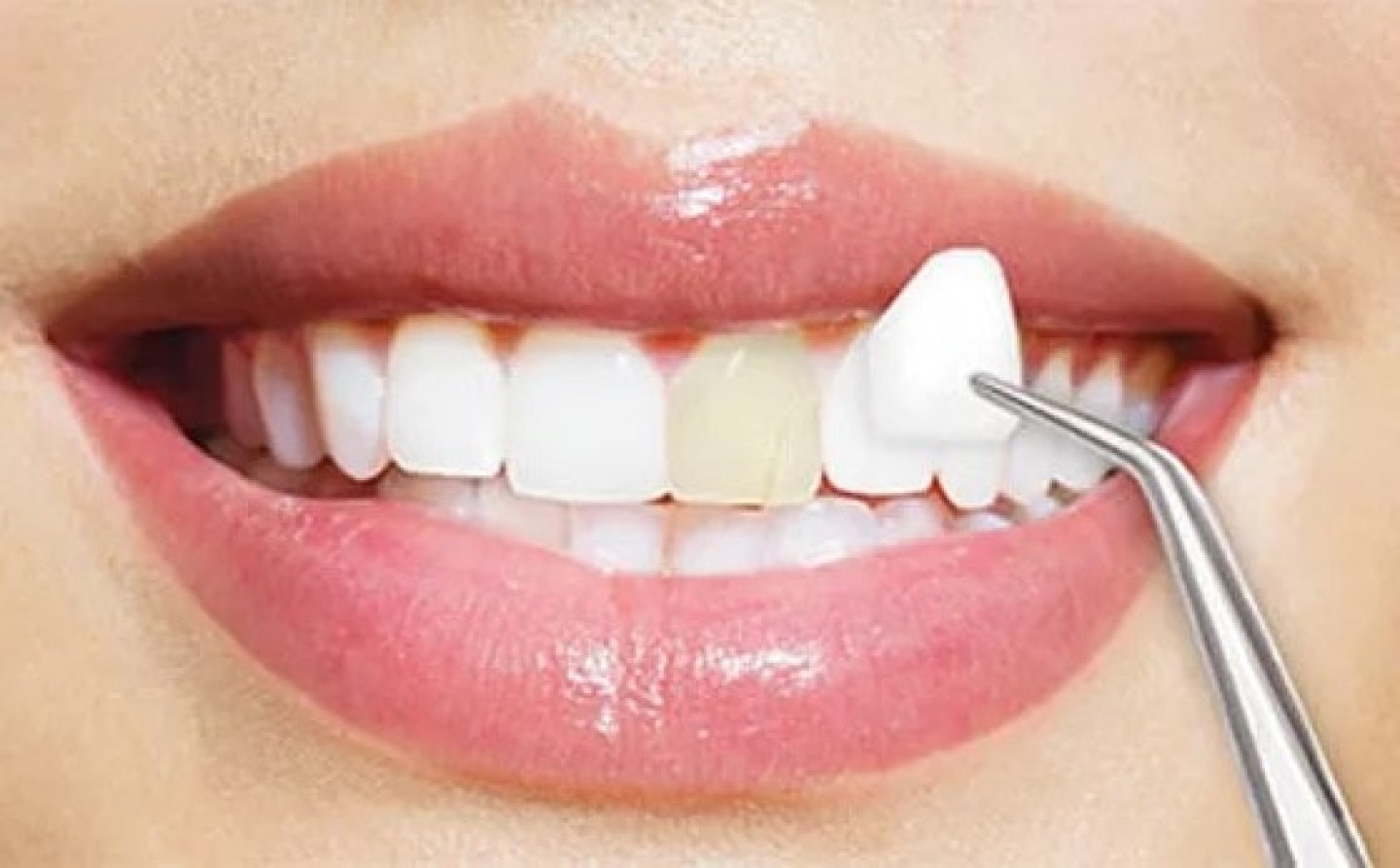 faccette dentali