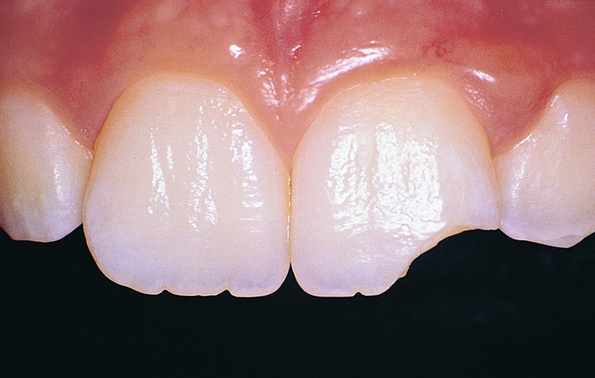 Trauma dentale